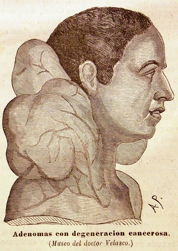 Modelo de busto con “adenomas con degeneraci&oacute;n cancerosa”, perteneciente al Museo Anat&oacute;mico-Patol&oacute;gico de Atocha 90 (El Anfiteatro Anat&oacute;mico Espa&ntilde;ol, nº 4, 15 de marzo de 1873, p. 48)