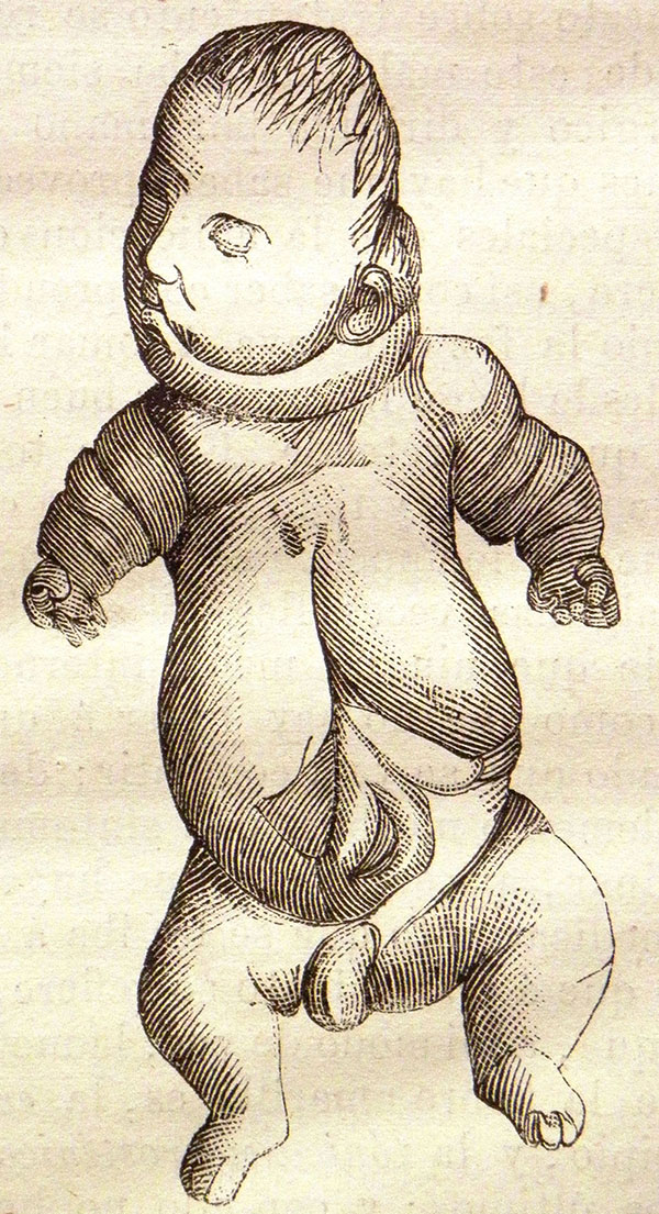“Feto monstruoso”, conservado en el museo de Atocha 90 (El Anfiteatro Anat&oacute;mico Espa&ntilde;ol, nº 22, 15 de diciembre de 1873, p. 262)